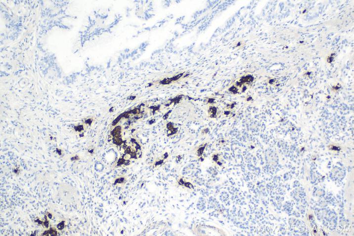 IHC analysis of human pancreas cancer tissue using Proteintech’s Insulin mouse monoclonal  antibody (66198-1-Ig) and IHC Detect Kit for Rabbit/Mouse Primary Antibody (PK10006). 