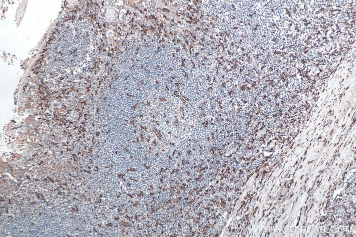 IHC analysis of human tonsillitis tissue using Proteintech’s IBA1 rabbit polyclonal antibody (10904-1-Ap) and IHC Detect Kit for Rabbit Primary Antibody (PK10009). 