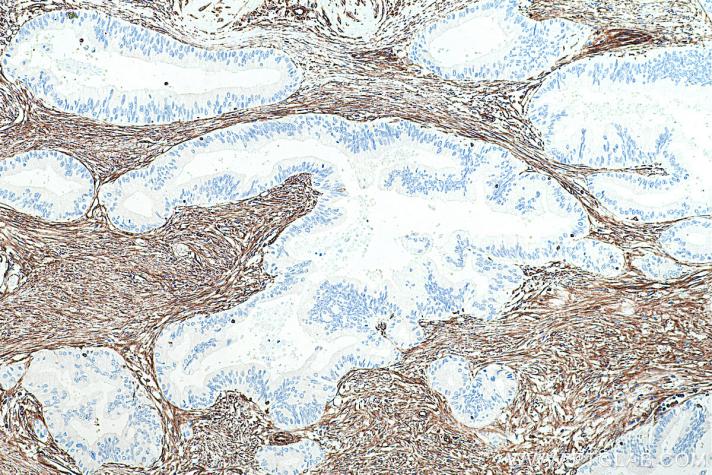 IHC analysis of human pancreas tissue using Proteintech’s Vimentin mouse monoclonal antibody (60330-1-Ig) and IHC Prep & Detect Kit for Mouse Primary Antibody (PK10018).