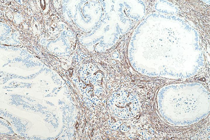 IHC analysis of human pancreas tissue using Proteintech’s Vimentin mouse monoclonal  antibody (60330-1-Ig) and IHC Prep & Detect Kit for Rabbit/Mouse Primary Antibody (PK10019). 