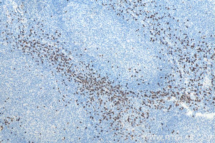 IHC analysis of human tonsillitis tissue with Proteintech’s CD8 mouse monoclonal antibody (66868-1-Ig). Heat-induced epitope retrieval was performed using Tris-EDTA Antigen Retrieval Buffer (PR30002).