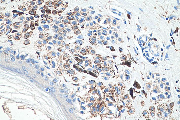 IHC analysis of human malignant melanoma tissue with Proteintech’s ALPP mouse monoclonal antibody (60294-1-Ig). Protease-induced epitope retrieval was performed by incubating at 37°C for 15 minutes in Protease K Antigen Retrieval Buffer (PR30014).