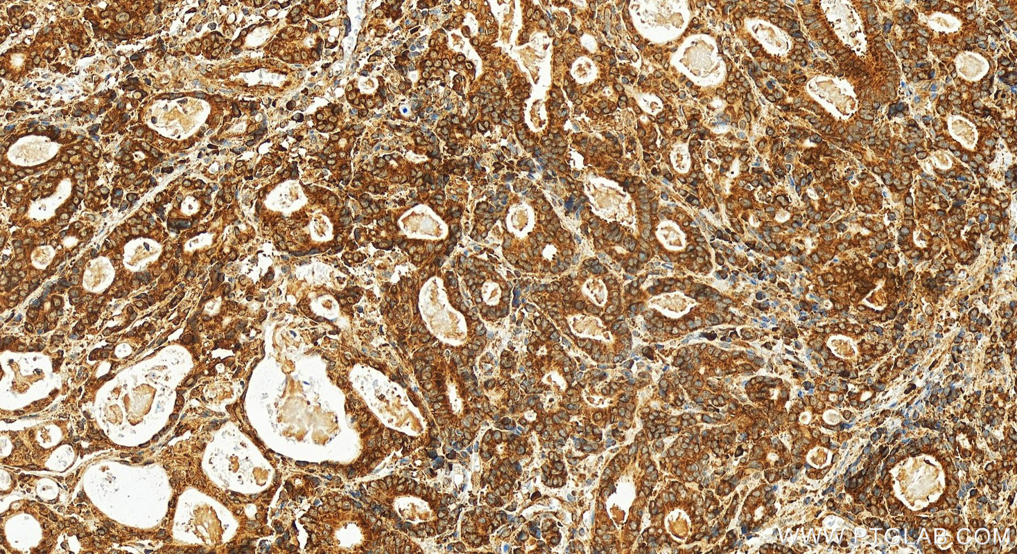 Immunohistochemistry (IHC) staining of human stomach cancer tissue using Ribosomal protein L4 Recombinant antibody (80959-1-RR)