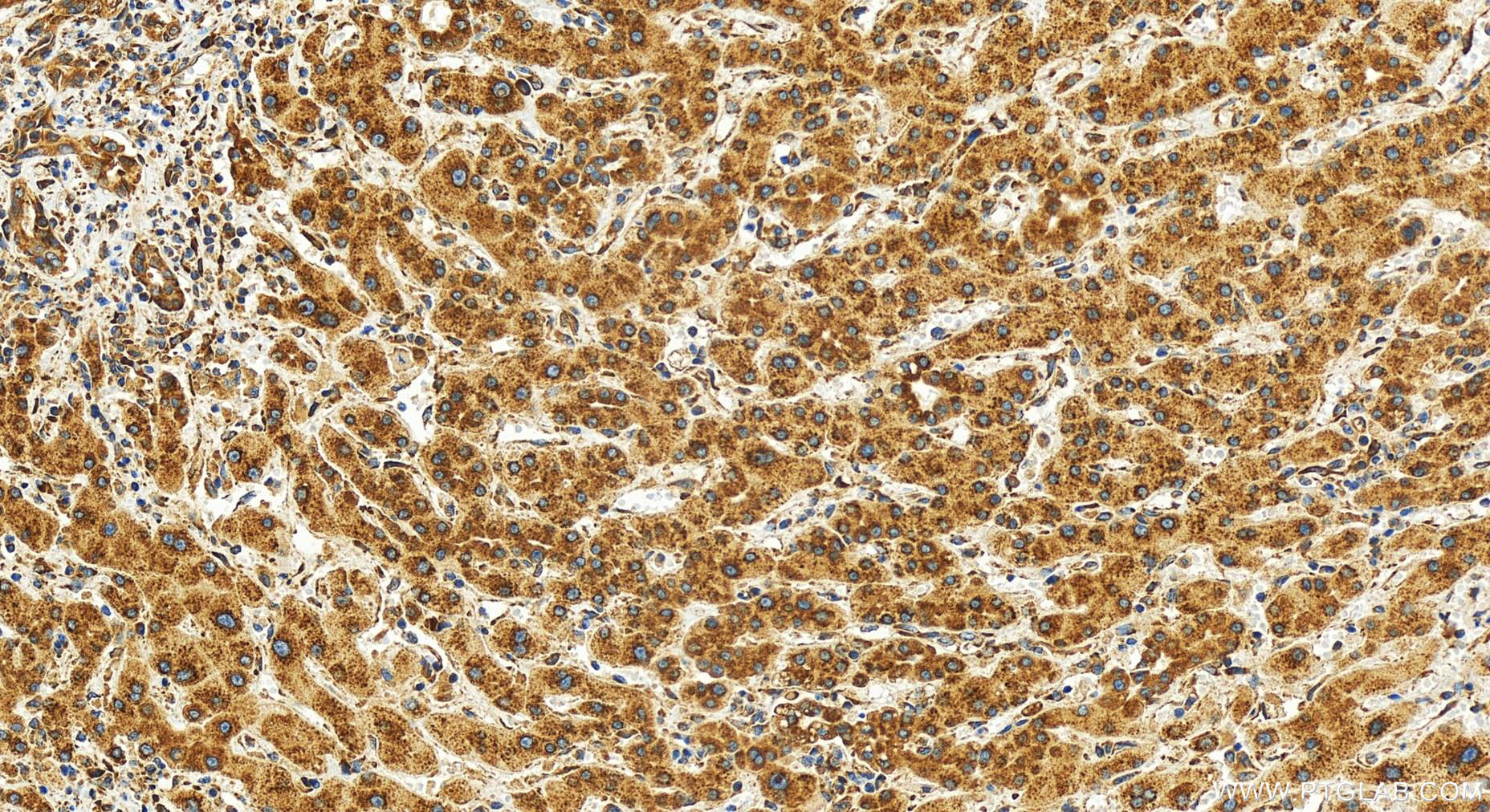 Immunohistochemistry (IHC) staining of human intrahepatic cholangiocarcinoma tissue using Ribosomal protein L4 Recombinant antibody (80959-1-RR)