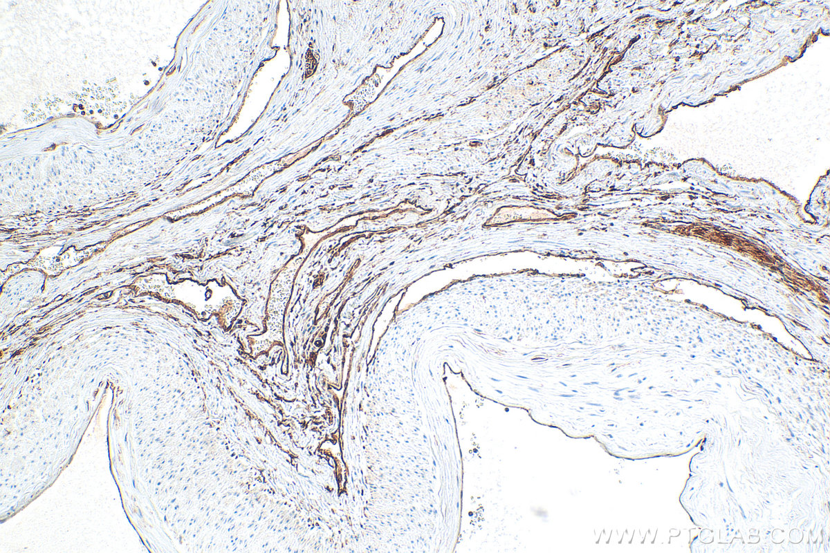 Immunohistochemistry (IHC) staining of human cervical cancer tissue using S100A10 Monoclonal antibody (66227-1-Ig)