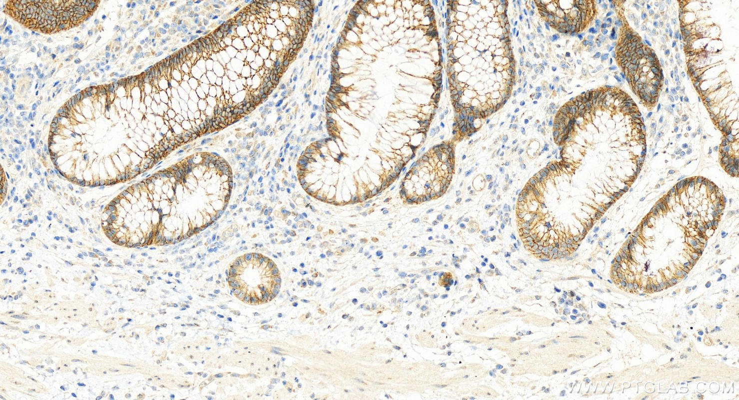 Immunohistochemistry (IHC) staining of human colon cancer tissue using S100A14 Polyclonal antibody (10489-1-AP)