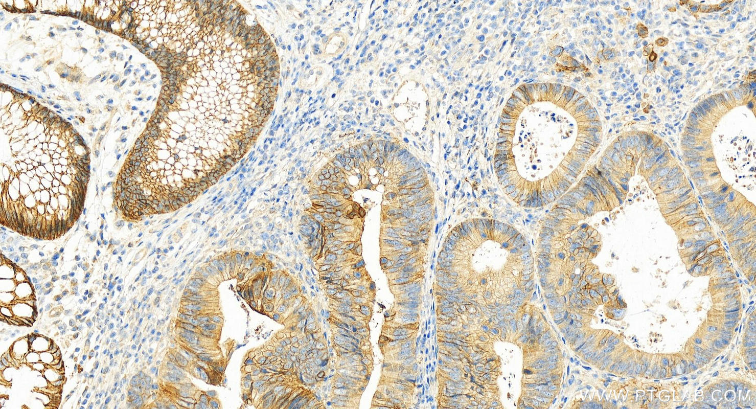 Immunohistochemistry (IHC) staining of human colon cancer tissue using S100A14 Polyclonal antibody (10489-1-AP)