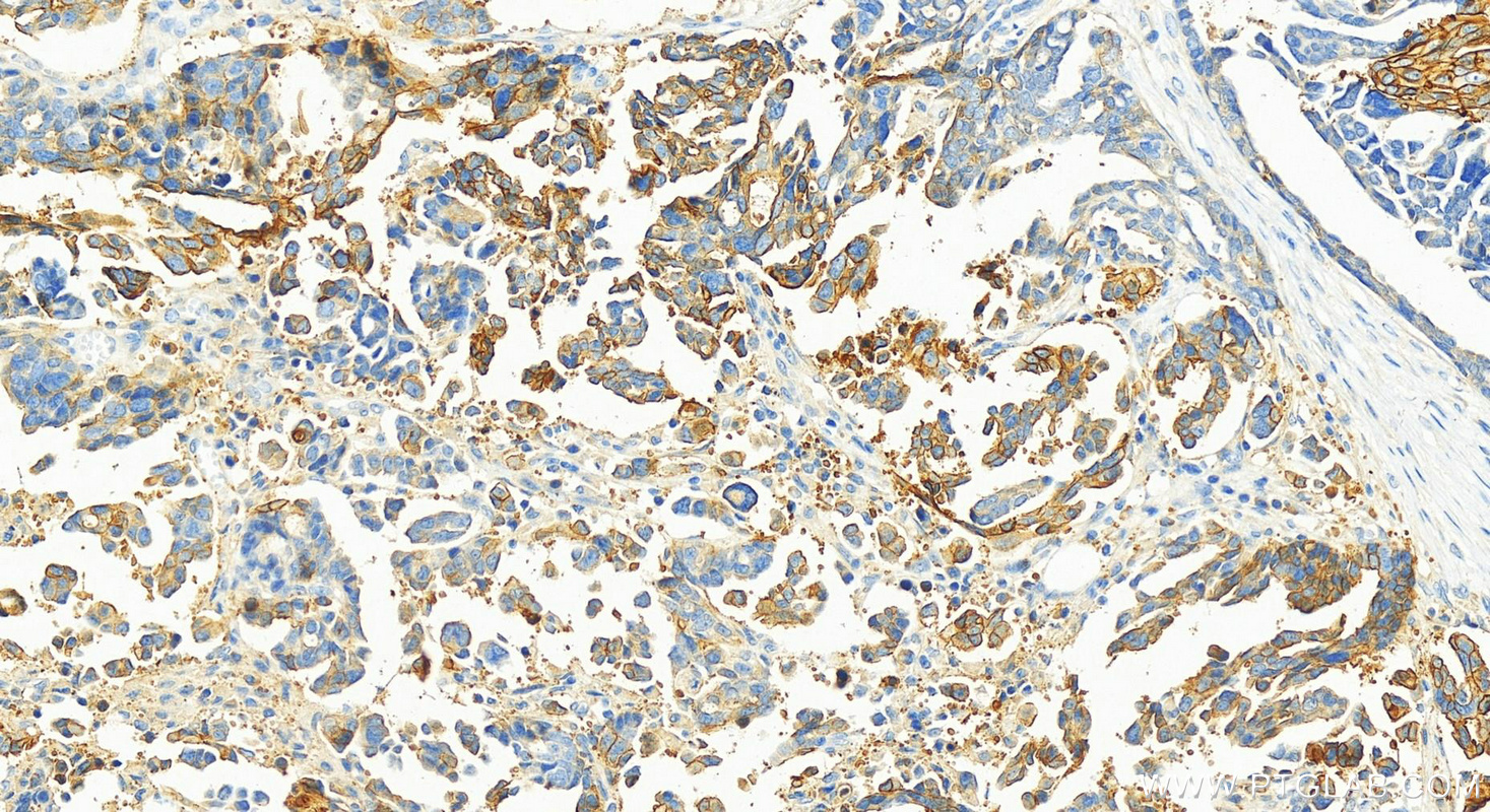 Immunohistochemistry (IHC) staining of human ovary cancer tissue using S100A14 Polyclonal antibody (10489-1-AP)