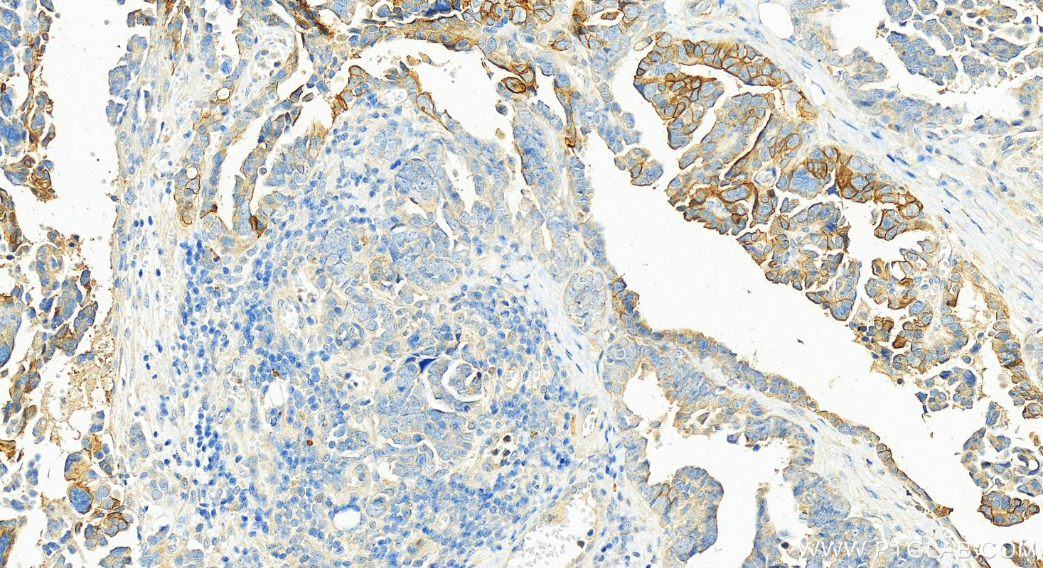 Immunohistochemistry (IHC) staining of human ovary cancer tissue using S100A14 Polyclonal antibody (10489-1-AP)