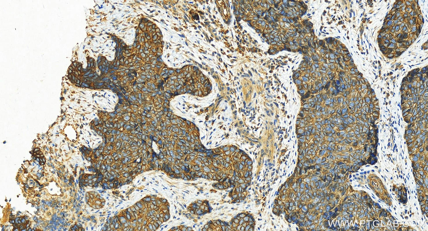 Immunohistochemistry (IHC) staining of human bowen disease using S100A14 Polyclonal antibody (10489-1-AP)