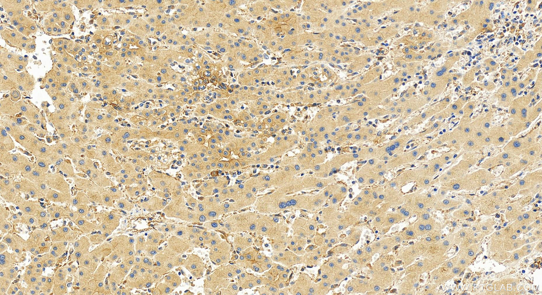 Immunohistochemistry (IHC) staining of human intrahepatic cholangiocarcinoma tissue using S100A14 Recombinant antibody (83559-5-RR)