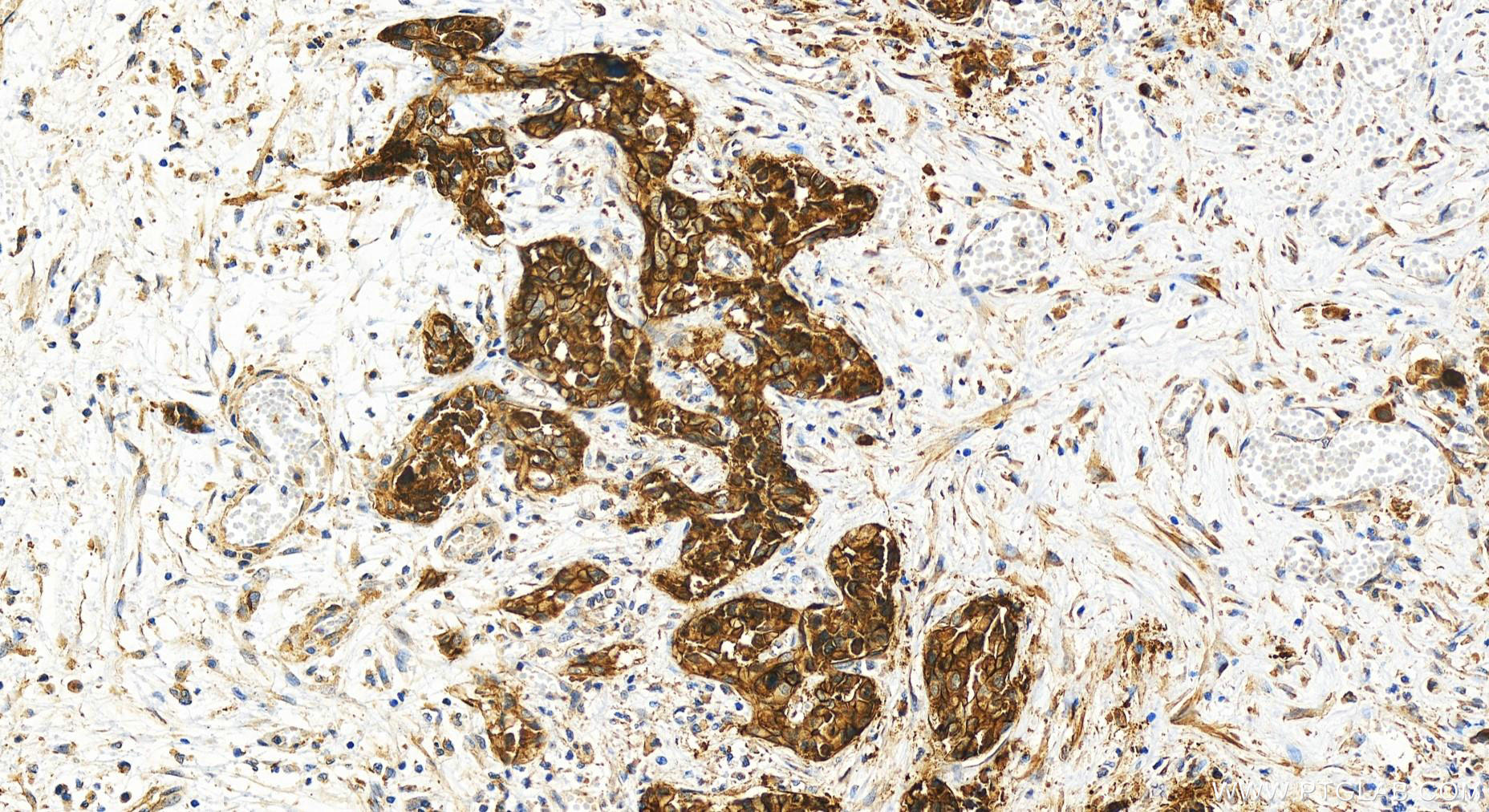 Immunohistochemistry (IHC) staining of human intrahepatic cholangiocarcinoma tissue using S100A14 Recombinant antibody (83559-5-RR)