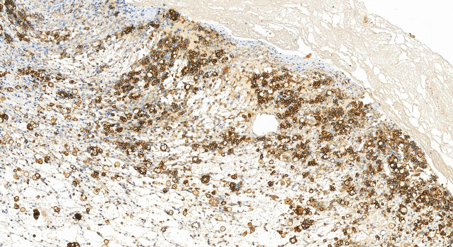 Immunohistochemistry (IHC) staining of human ovary cancer tissue using S100A14 Recombinant antibody (83559-5-RR)