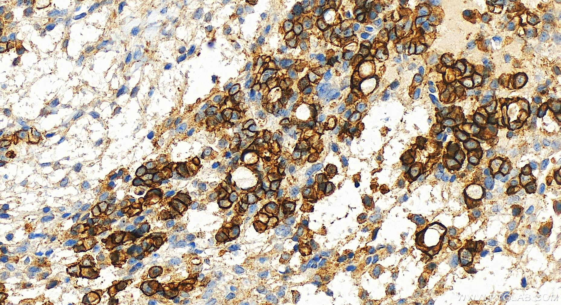 Immunohistochemistry (IHC) staining of human ovary cancer tissue using S100A14 Recombinant antibody (83559-5-RR)