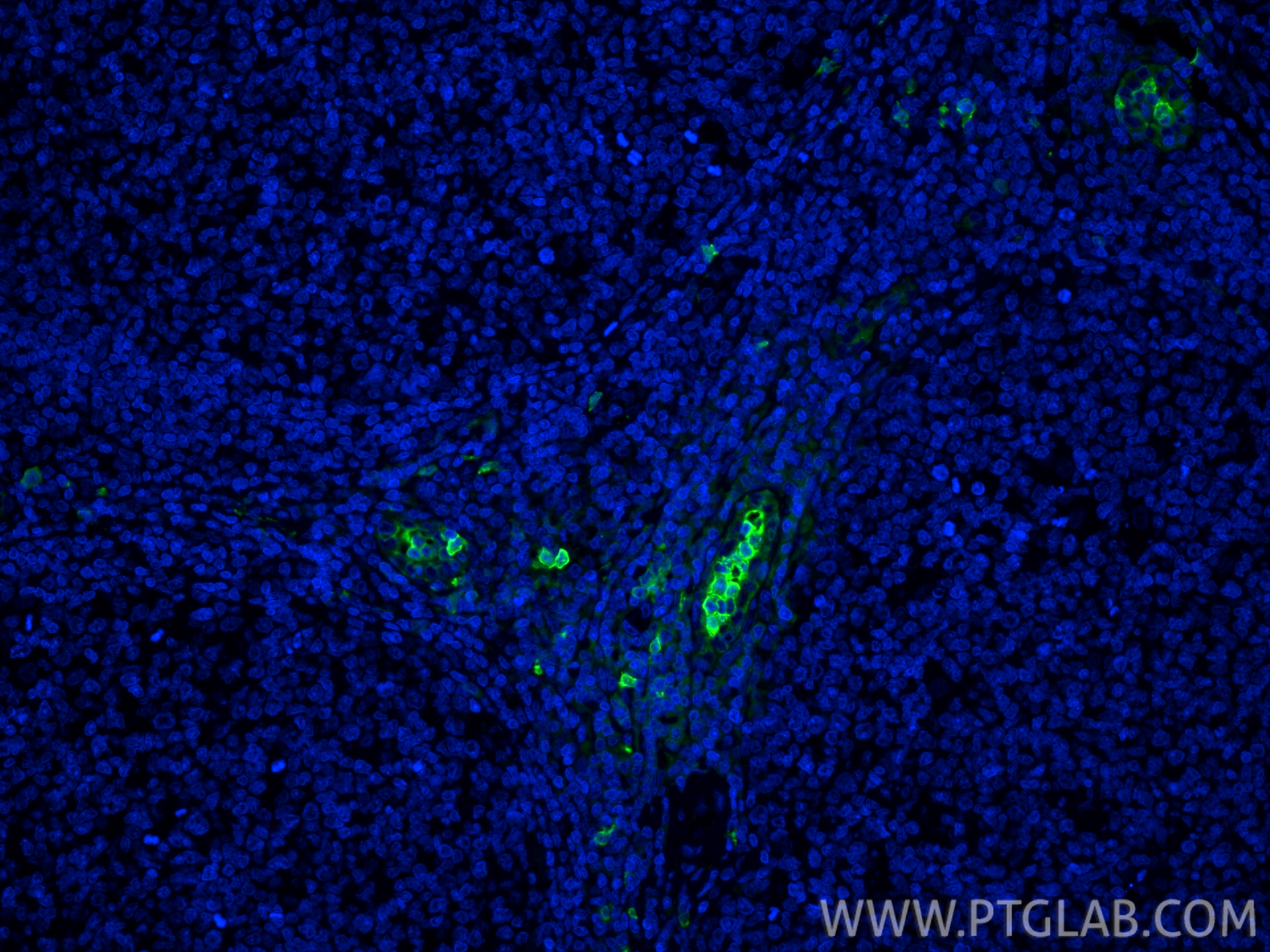Immunofluorescence (IF) / fluorescent staining of human tonsillitis tissue using S100A9 Polyclonal antibody (26992-1-AP)