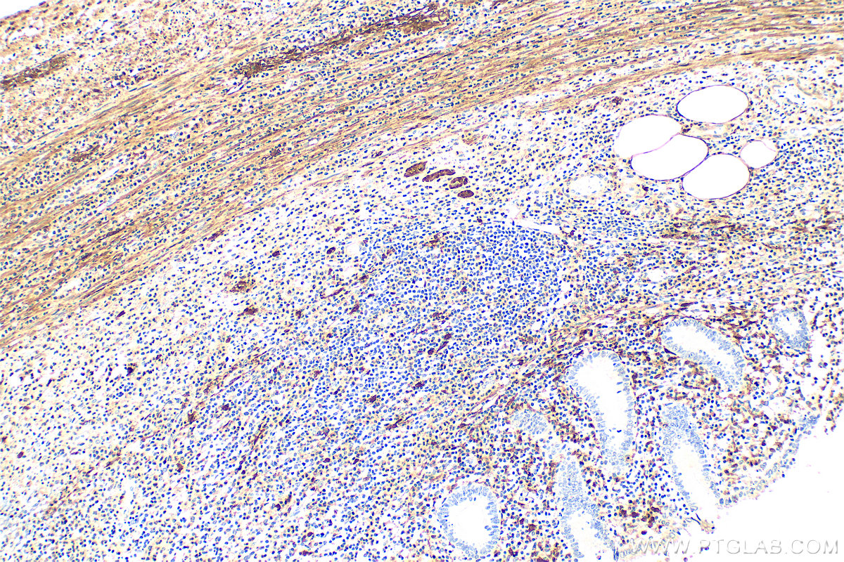 Immunohistochemistry (IHC) staining of human appendicitis tissue using S100B Polyclonal antibody (15146-1-AP)