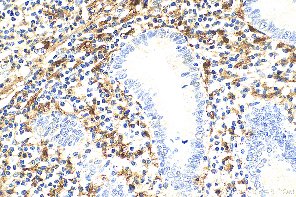 Immunohistochemistry (IHC) staining of human appendicitis tissue using S100B Polyclonal antibody (15146-1-AP)