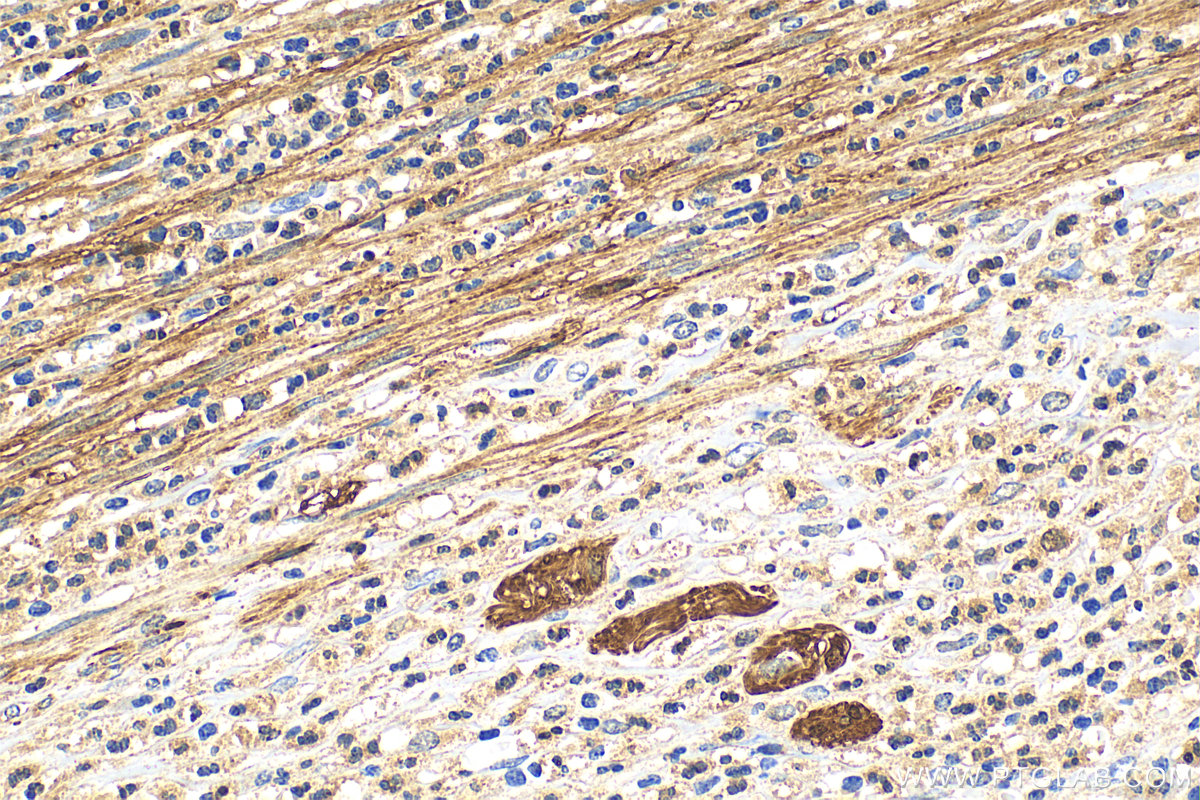 Immunohistochemistry (IHC) staining of human appendicitis tissue using S100B Polyclonal antibody (15146-1-AP)