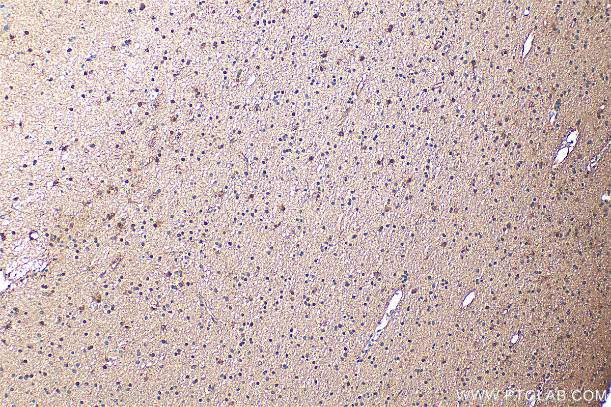 Immunohistochemistry (IHC) staining of human gliomas tissue using S100B Polyclonal antibody (15146-1-AP)