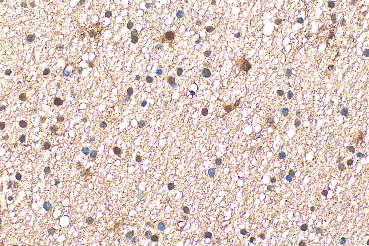 Immunohistochemistry (IHC) staining of human gliomas tissue using S100B Polyclonal antibody (15146-1-AP)