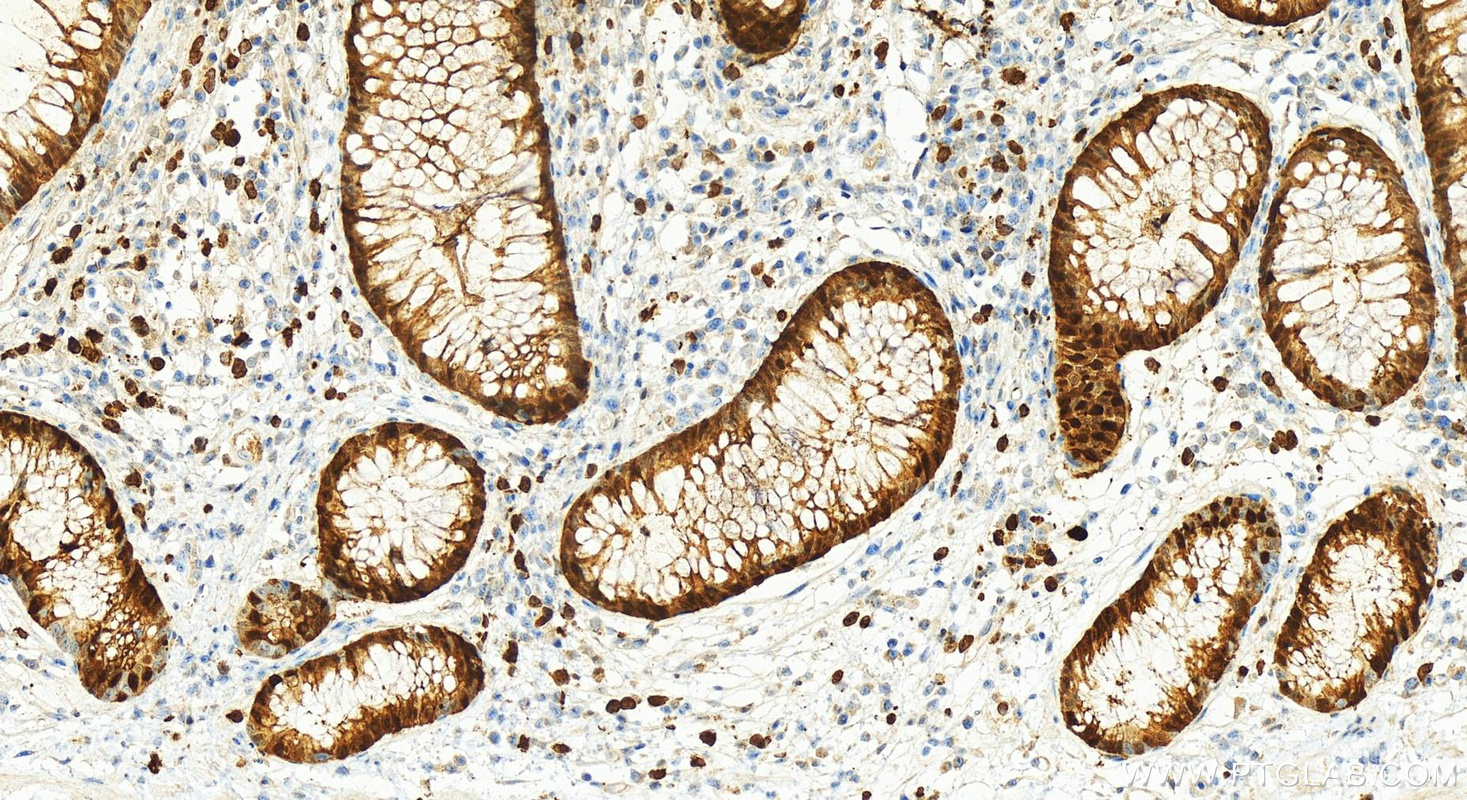 Immunohistochemistry (IHC) staining of human colon cancer tissue using S100P Polyclonal antibody (11803-1-AP)