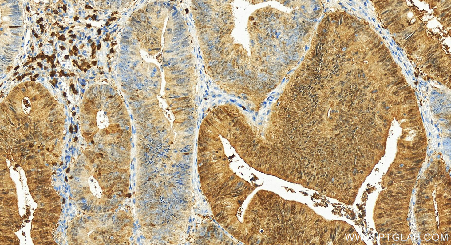 Immunohistochemistry (IHC) staining of human colon cancer tissue using S100P Polyclonal antibody (11803-1-AP)