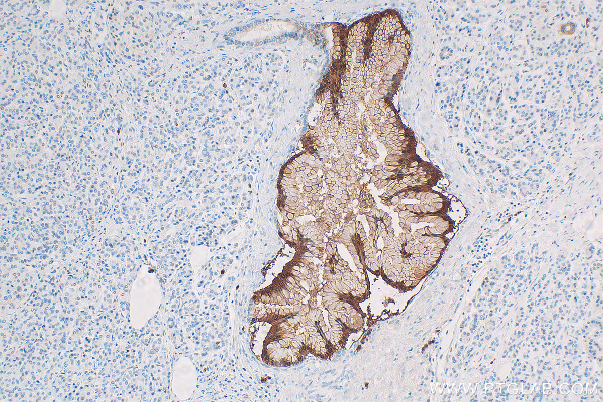 Immunohistochemistry (IHC) staining of human pancreas cancer tissue using S100P Polyclonal antibody (11803-1-AP)