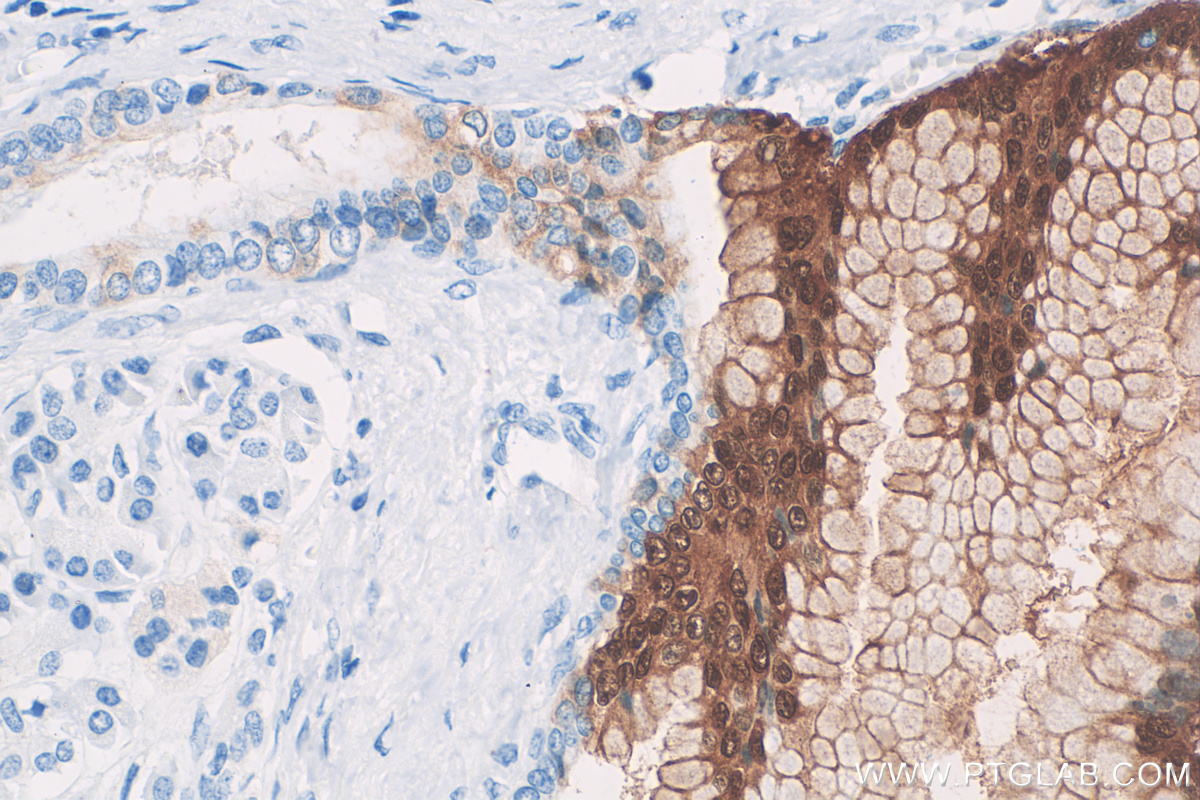 Immunohistochemistry (IHC) staining of human pancreas cancer tissue using S100P Polyclonal antibody (11803-1-AP)