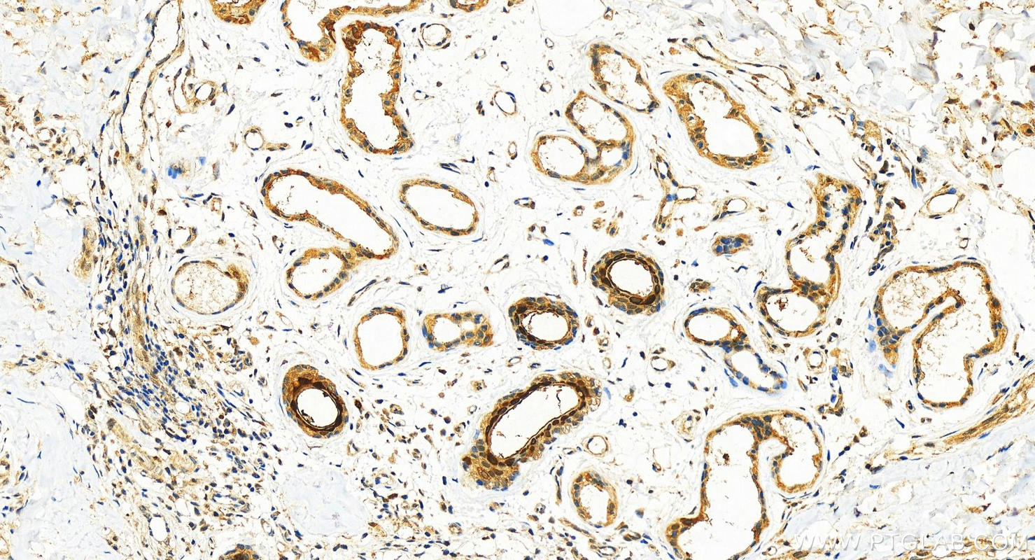 Immunohistochemistry (IHC) staining of human bowen disease using S100P Polyclonal antibody (11803-1-AP)