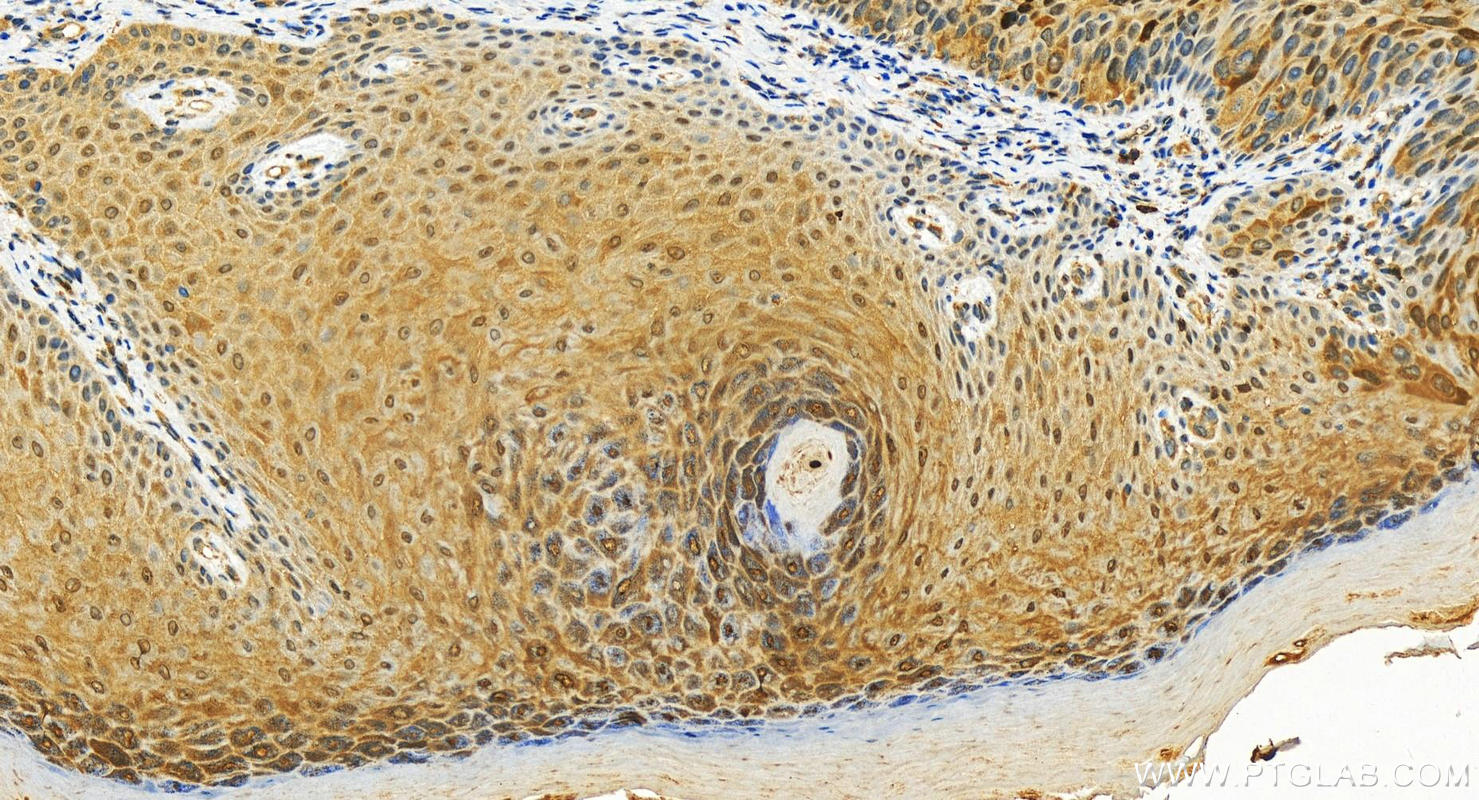 Immunohistochemistry (IHC) staining of human bowen disease tissue using S100P Polyclonal antibody (11803-1-AP)