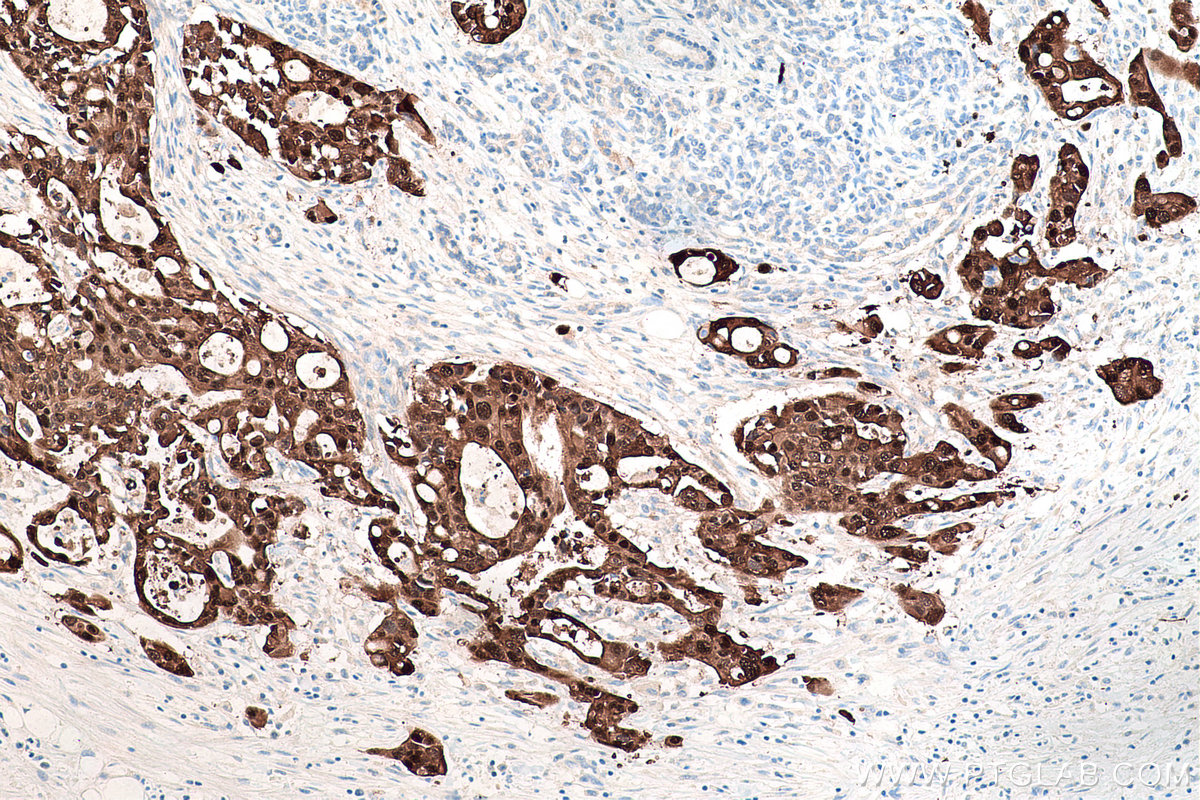 Immunohistochemistry (IHC) staining of human pancreas cancer tissue using S100P Monoclonal antibody (67485-1-Ig)