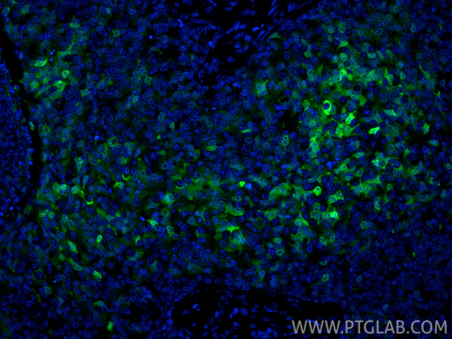 Immunofluorescence (IF) / fluorescent staining of human breast cancer tissue using CoraLite® Plus 488-conjugated S100P Polyclonal ant (CL488-11803)