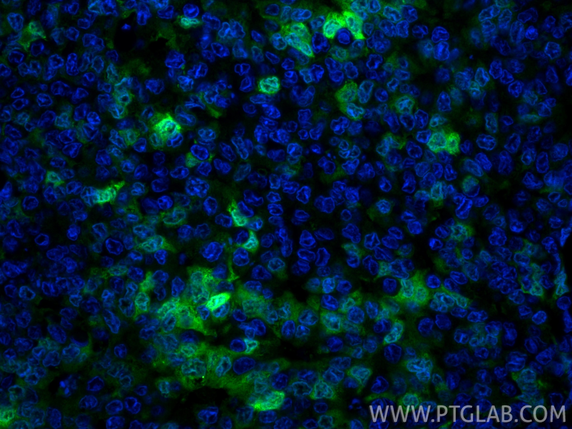 Immunofluorescence (IF) / fluorescent staining of human breast cancer tissue using CoraLite® Plus 488-conjugated S100P Polyclonal ant (CL488-11803)