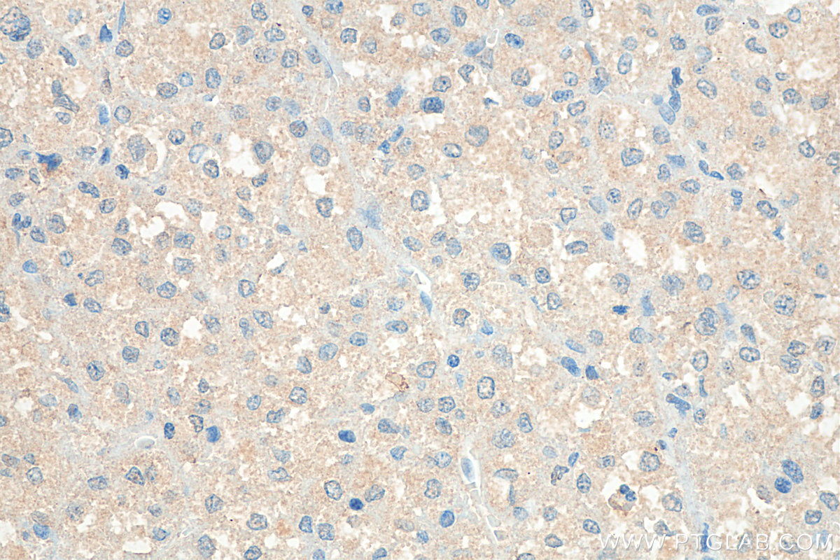 Immunohistochemistry (IHC) staining of human liver cancer tissue using SAA1 Polyclonal antibody (16721-1-AP)