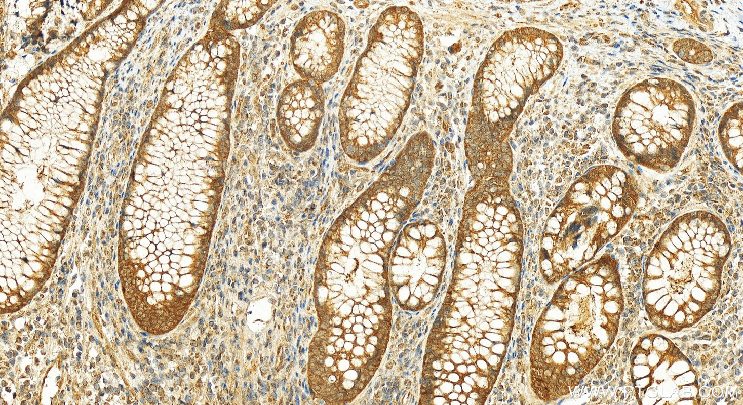 Immunohistochemistry (IHC) staining of human colon cancer tissue using SAC3D1 Polyclonal antibody (25857-1-AP)