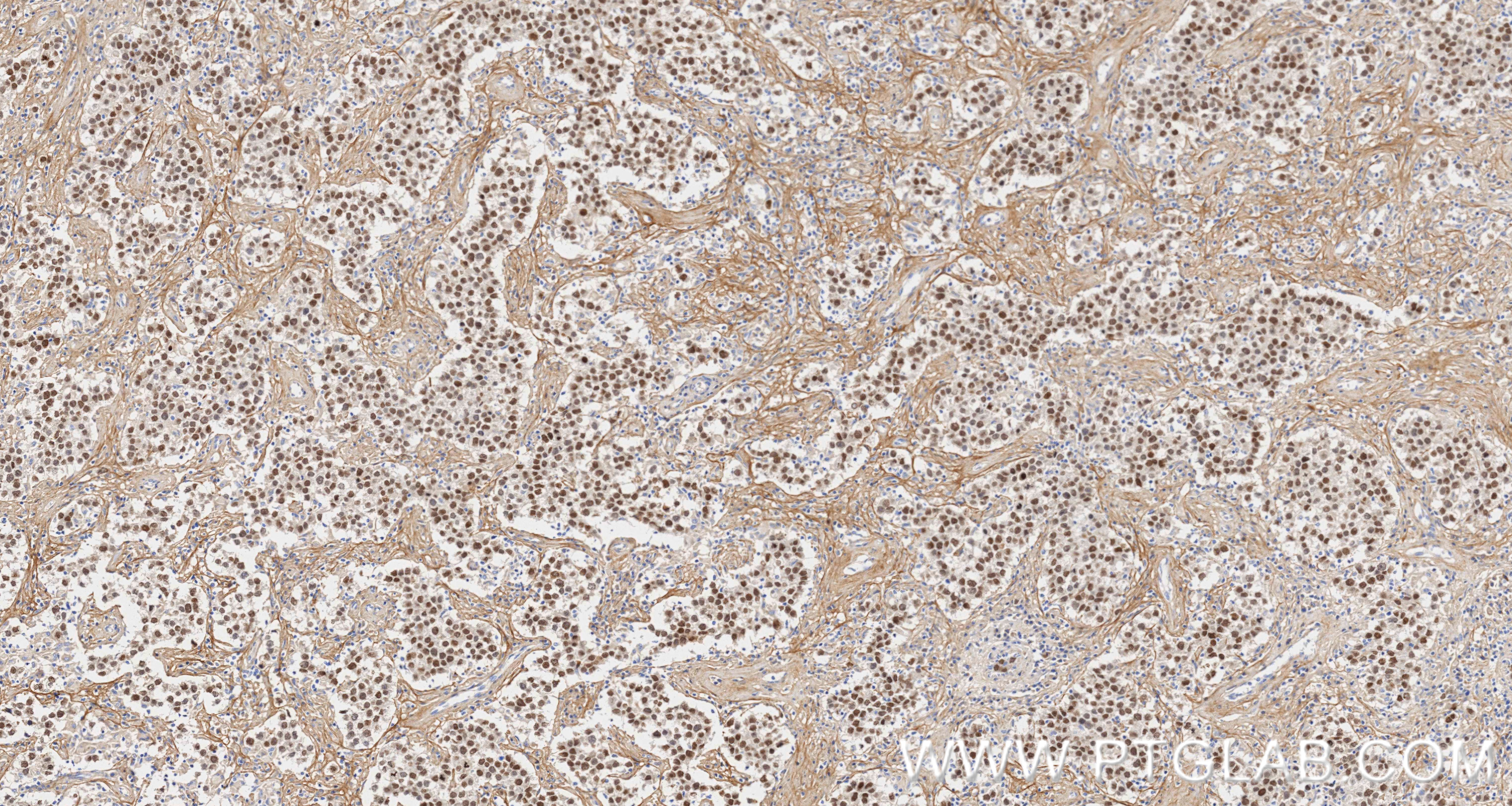 Immunohistochemistry (IHC) staining of Human seminoma using SALL4 Recombinant monoclonal antibody (83039-4-RR)