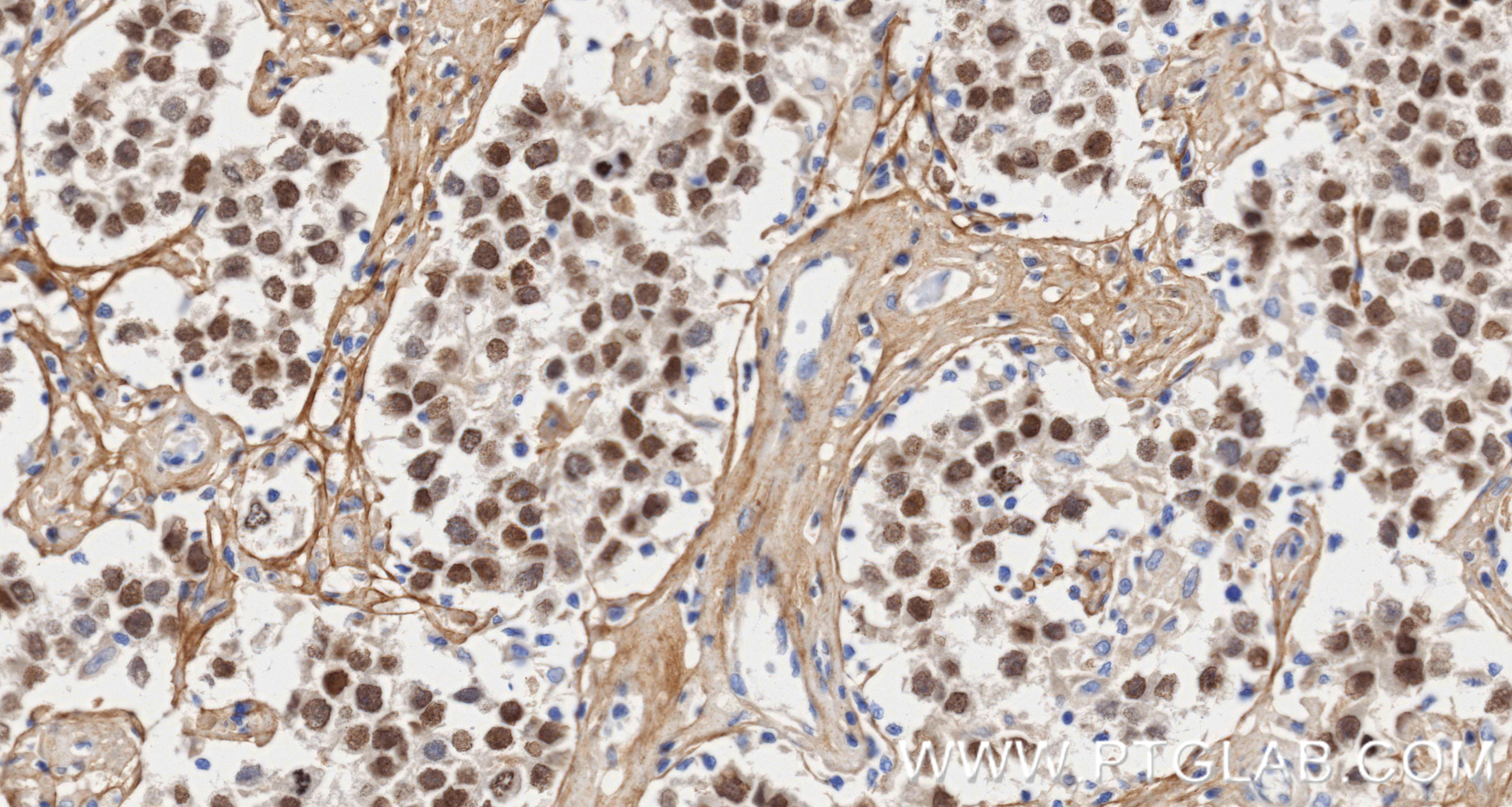 Immunohistochemistry (IHC) staining of Human seminoma using SALL4 Recombinant monoclonal antibody (83039-4-RR)