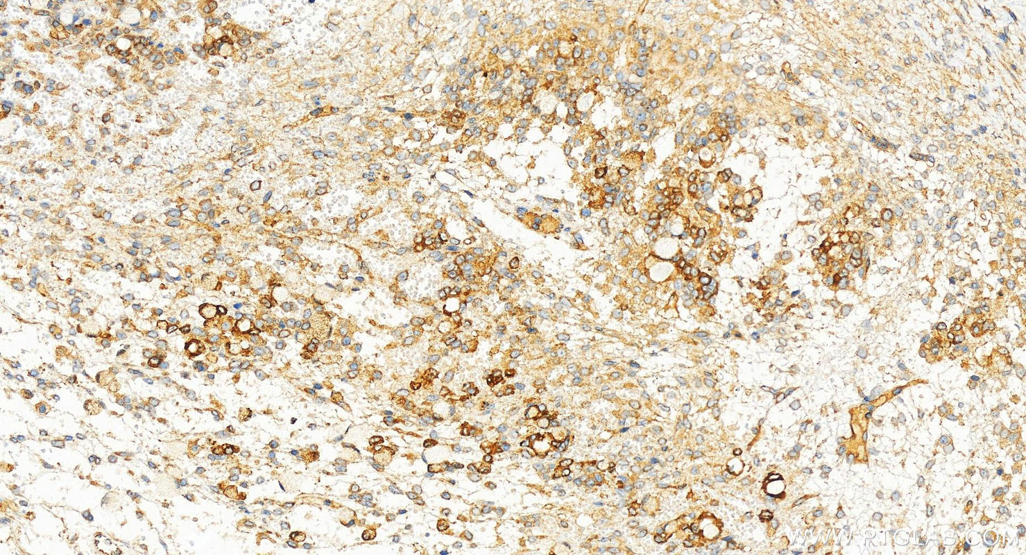 Immunohistochemistry (IHC) staining of human ovary cancer tissue using SAMD9 Polyclonal antibody (22786-1-AP)