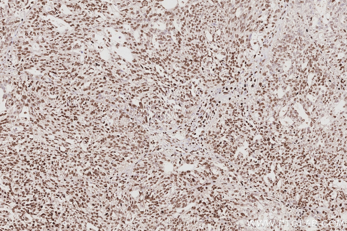 Immunohistochemistry (IHC) staining of human ovary cancer tissue using SAMHD1 Polyclonal antibody (12586-1-AP)