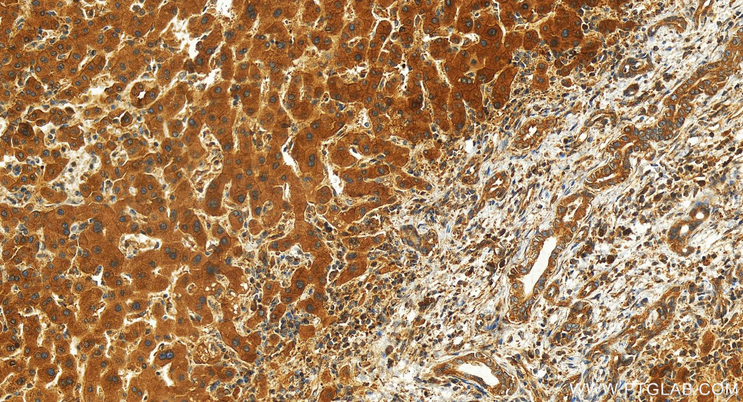 Immunohistochemistry (IHC) staining of human intrahepatic cholangiocarcinoma tissue using SAPS2 Polyclonal antibody (26190-1-AP)