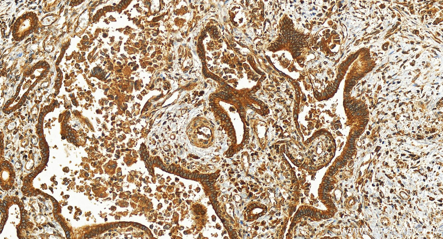 Immunohistochemistry (IHC) staining of human intrahepatic cholangiocarcinoma tissue using SAPS2 Polyclonal antibody (26190-1-AP)