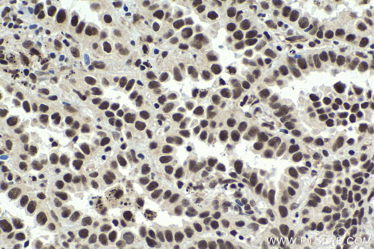 Immunohistochemistry (IHC) staining of human lung cancer tissue using SART3 Polyclonal antibody (18025-1-AP)