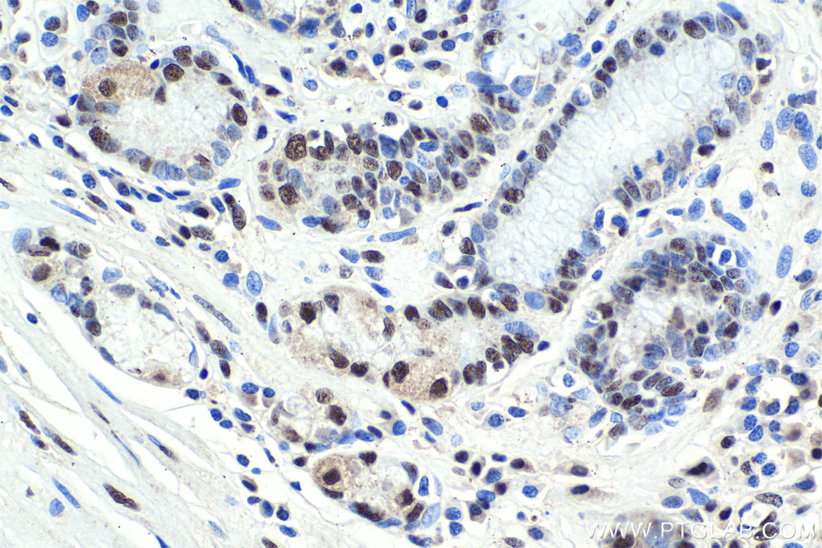 Immunohistochemistry (IHC) staining of human stomach cancer tissue using SART3 Polyclonal antibody (18025-1-AP)