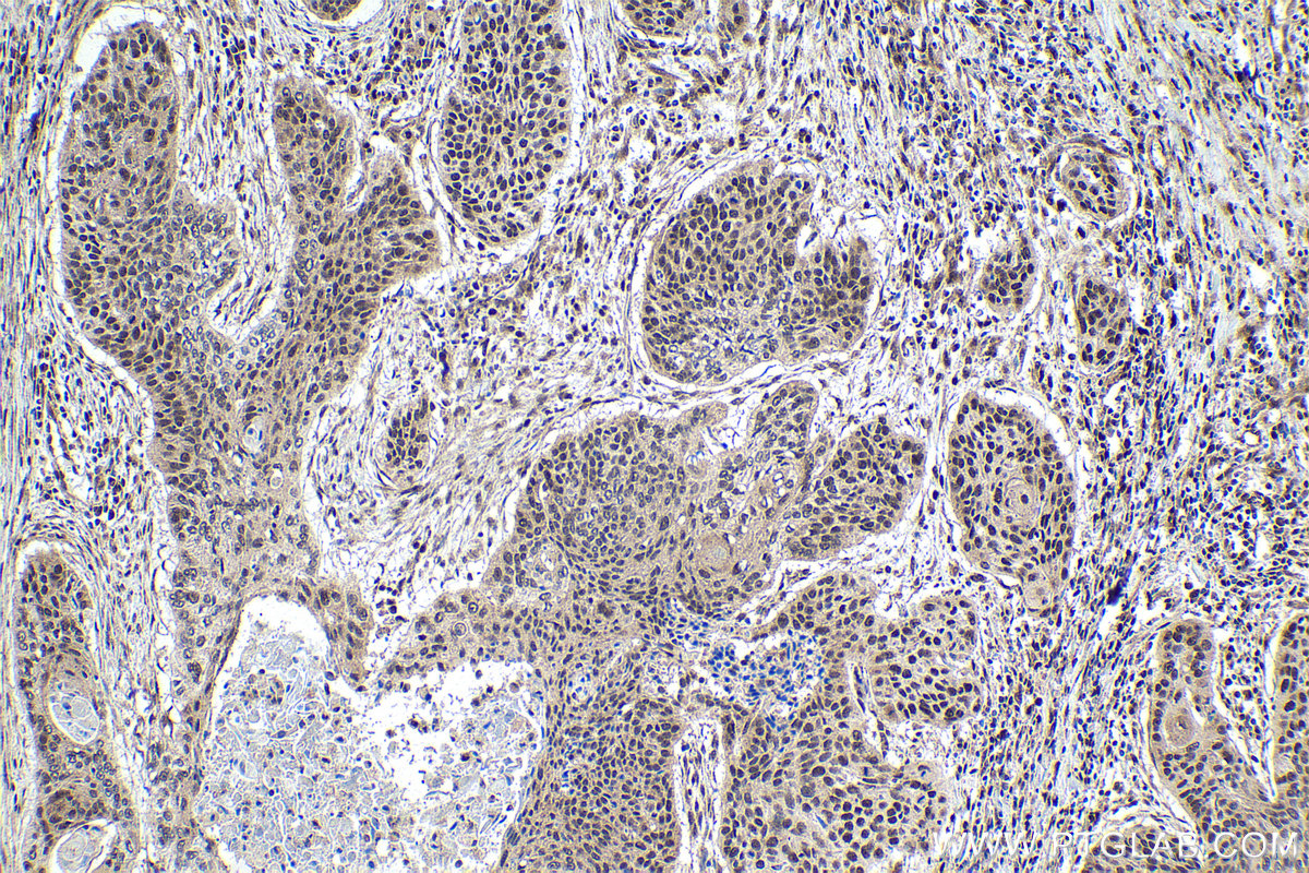 Immunohistochemistry (IHC) staining of human oesophagus cancer tissue using SATB1 Polyclonal antibody (15400-1-AP)