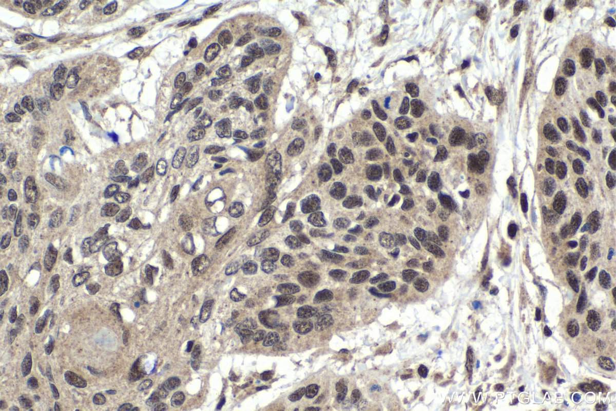 Immunohistochemistry (IHC) staining of human oesophagus cancer tissue using SATB1 Polyclonal antibody (15400-1-AP)