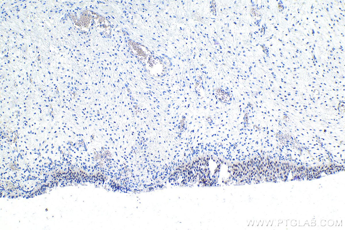 Immunohistochemistry (IHC) staining of human urothelial carcinoma tissue using SATB1 Polyclonal antibody (15400-1-AP)