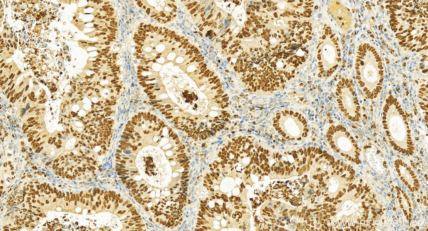 Immunohistochemistry (IHC) staining of human colon cancer tissue using SATB2 Polyclonal antibody (19557-1-AP)