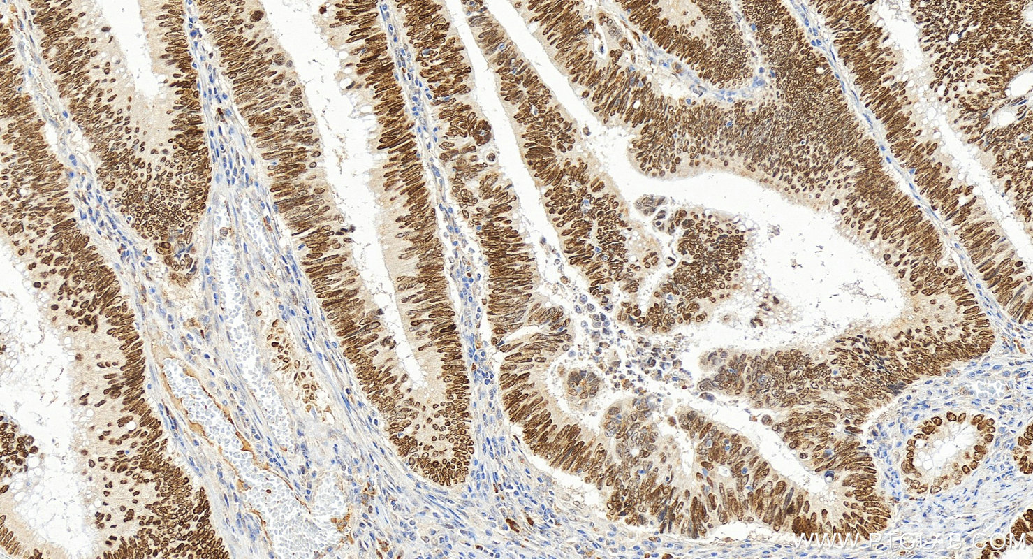 Immunohistochemistry (IHC) staining of human colon cancer tissue using SATB2 Polyclonal antibody (30717-1-AP)