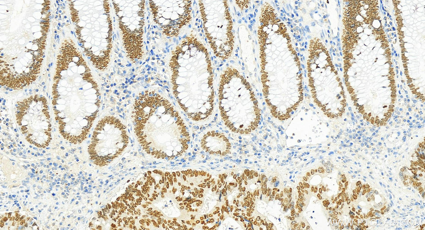 Immunohistochemistry (IHC) staining of human colon cancer tissue using SATB2 Monoclonal antibody (67958-1-Ig)