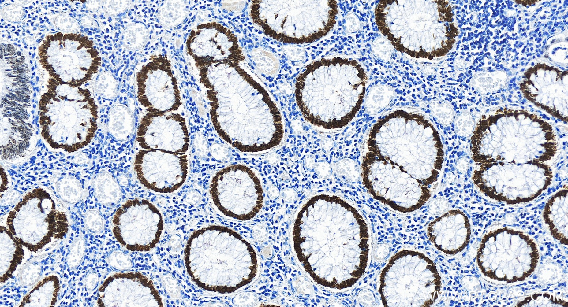 Immunohistochemistry (IHC) staining of human colon cancer tissue using SATB2 Recombinant antibody (85922-1-RR)